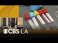 Doctor discusses new colon cancer screening guidelines