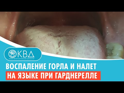 👅 Воспаление горла и налет на языке при гарднерелле. Клинический случай №928