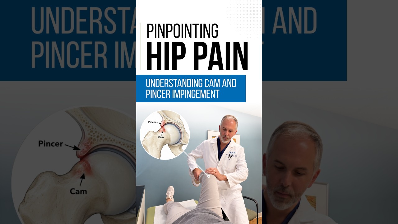 Pinpointing Hip Pain: CAM vs. Pincer Impingement