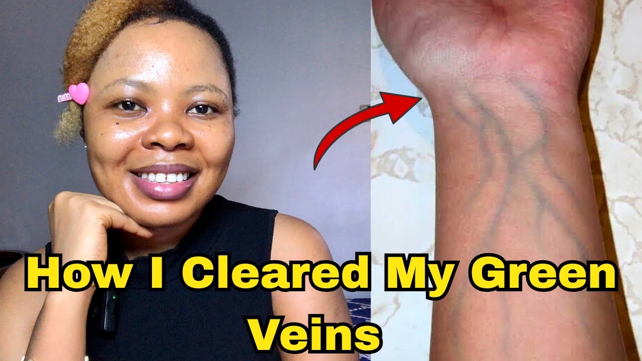 How To Clear Green Veins Permanently; Green Veins Treatment 2026 