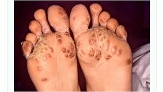 Keratoderma blennorrhagica in hindi / Tarang academy/ dermatology