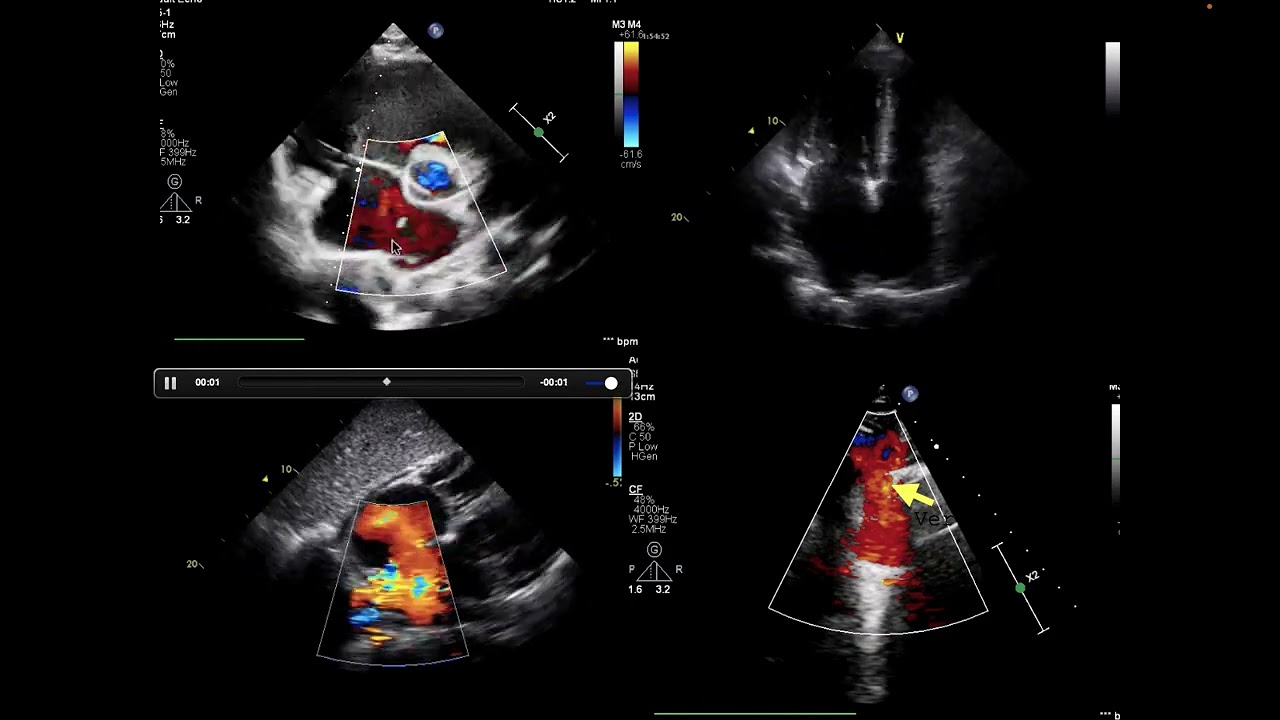 erişkinlerde atriyal septal defektlerde ekokardiyografik değerlendirme bölüm 1; ostium sekundum