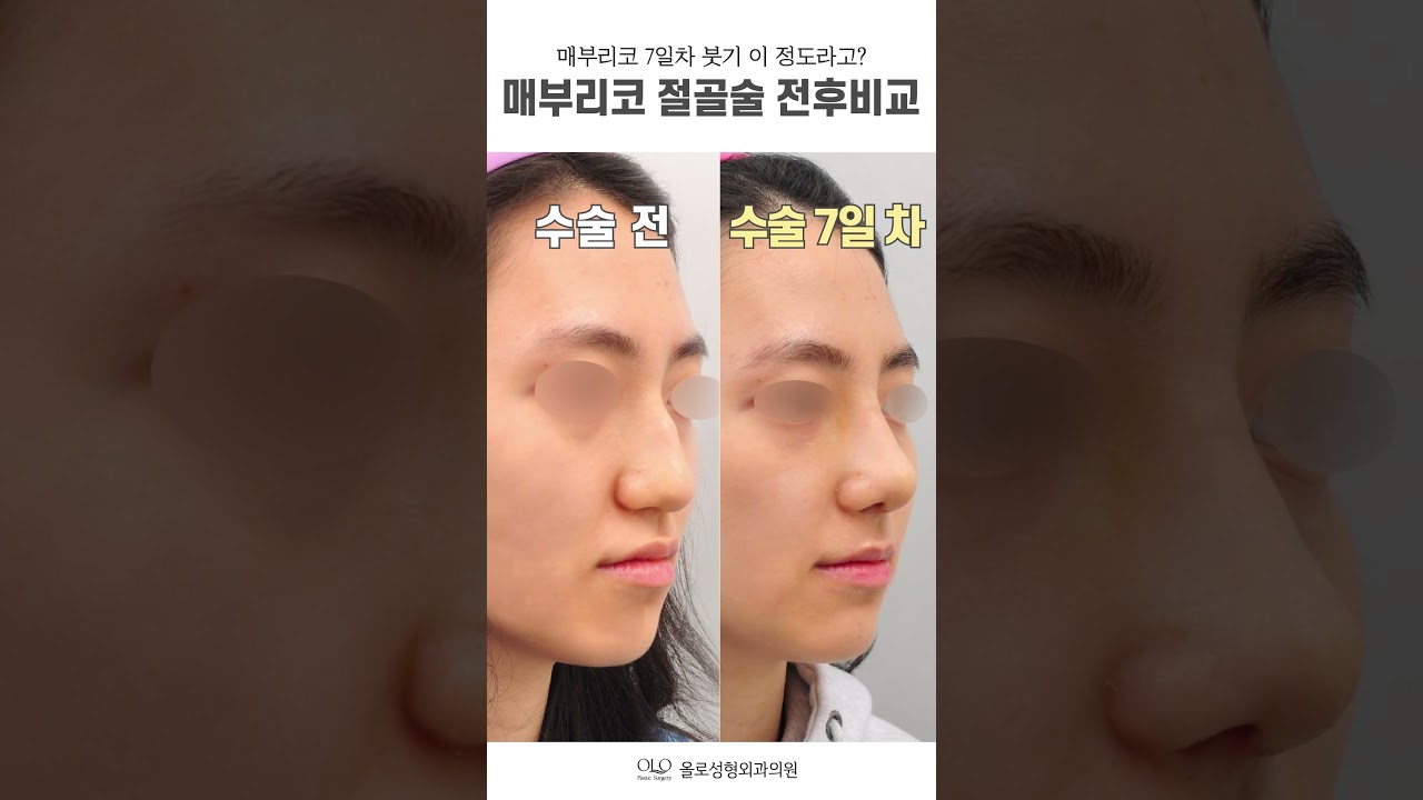 [奧樂整形外科診所] #鷹鉤鼻 第7天 腫脹 #是真的嗎 #鼻部整形 #奧樂整形外科 #整形外科專科醫師 #easy | 鼻部整形 | 鷹鉤鼻整形