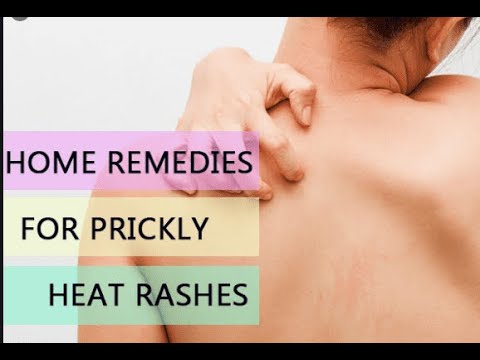 WHAT IS HEAT RASH - YouTube