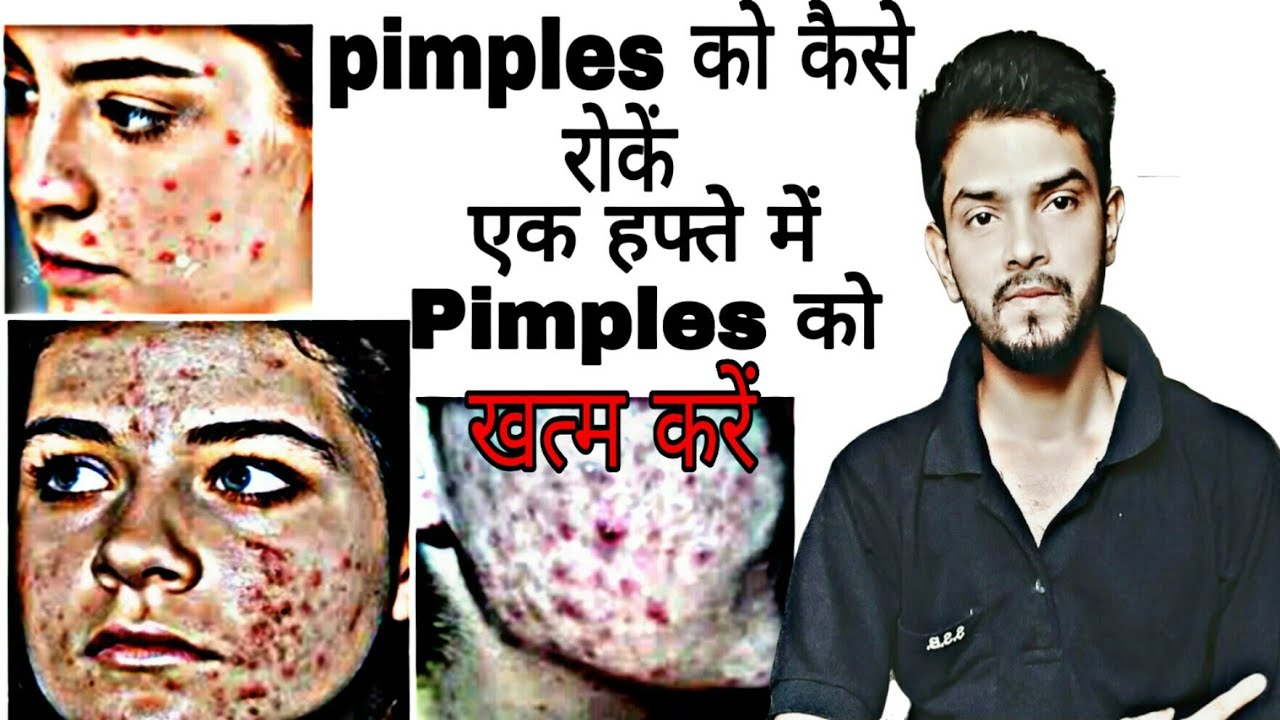 Pimple Free Skin Tips In Hindi Beauty & Health