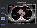 Approach to CT Chest  849
