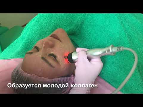 RF-лифтинг (радиоволновая подтяжка кожи)