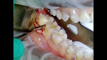 Extraction of Erupted Wisdom Tooth in an Older Patient. Elevation and Forceps.