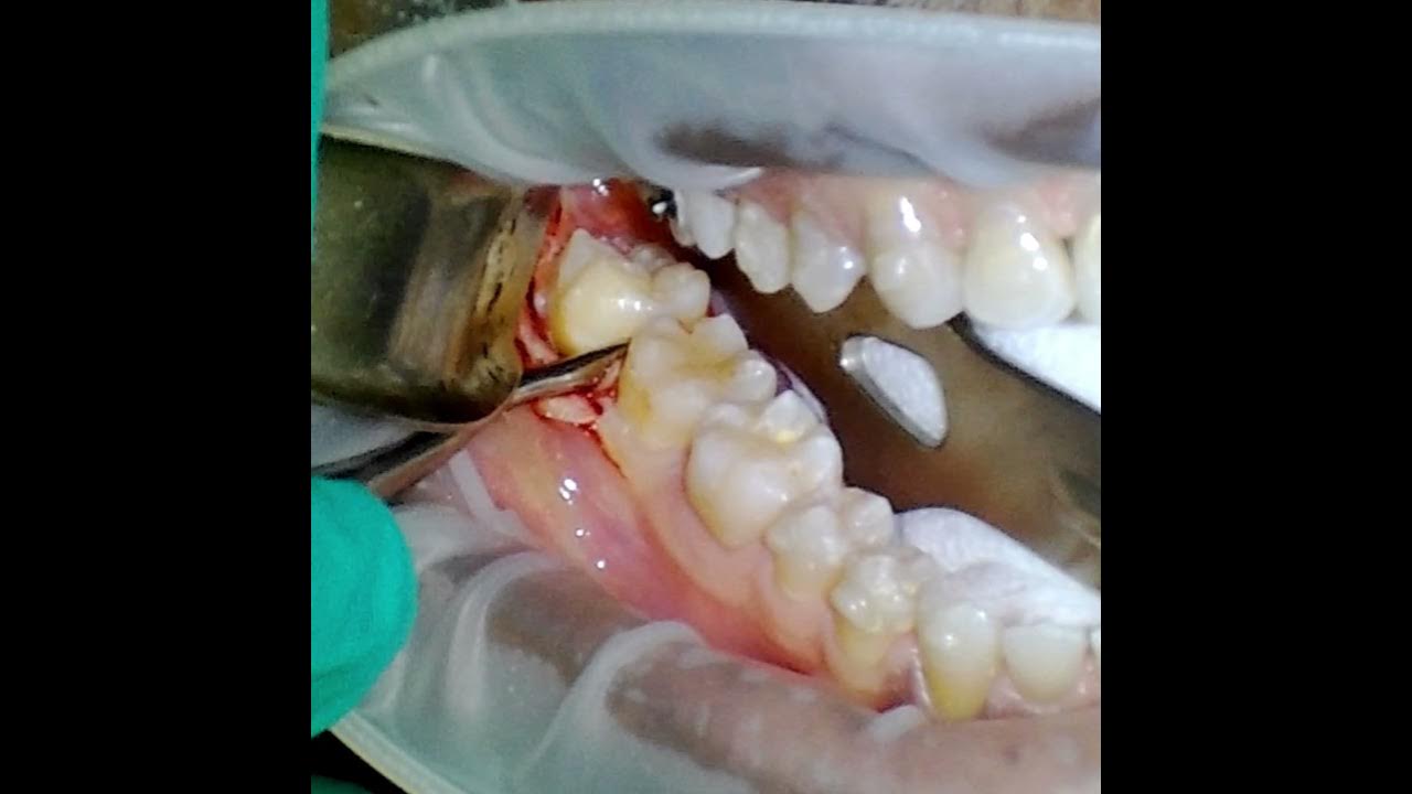 Extraction of Erupted Wisdom Tooth in an Older Patient. Elevation and