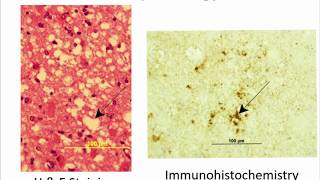 Prion Disease/CJD (Creutzfeld-Jakob Disease) Basics - Brian Appleby