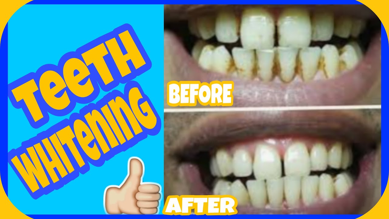 Teeth whitening at home in 3 minutes,  تبييض الاسنان في المنزل في 3 دقائق ،إزالة الاصفرار100٪ فعال