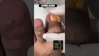 Unha encravada #podologia #nails #satisfying #unhaencravada