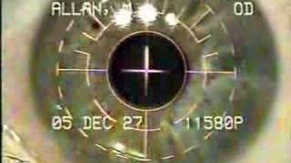 Download lagu See a Live PRK Laser Eye Surgery See a Live PRK Laser Eye Surgery