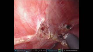 Liver Mobilization for Diaphragm Surgery - AAGL 2020