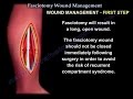 compartment syndrome ,Fasciotomy Wound Management - Everything You Need To Know - Dr. Nabil Ebraheim