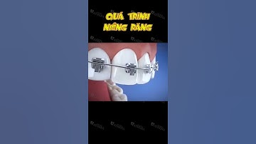 [3D] QÚA TRÌNH NIỀNG RĂNG || Nha Khoa Quốc Tế Athena