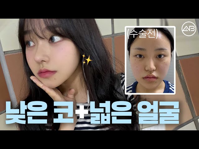 옆태미인 된 썰 푼다 | 후기있음 | 에이비성형외과