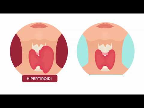 Hipertiroidi nedir? - Doç. Dr. Ethem Turgay Cerit (Endokrinoloji ve Metabolizma Hastalıkları Uz.)