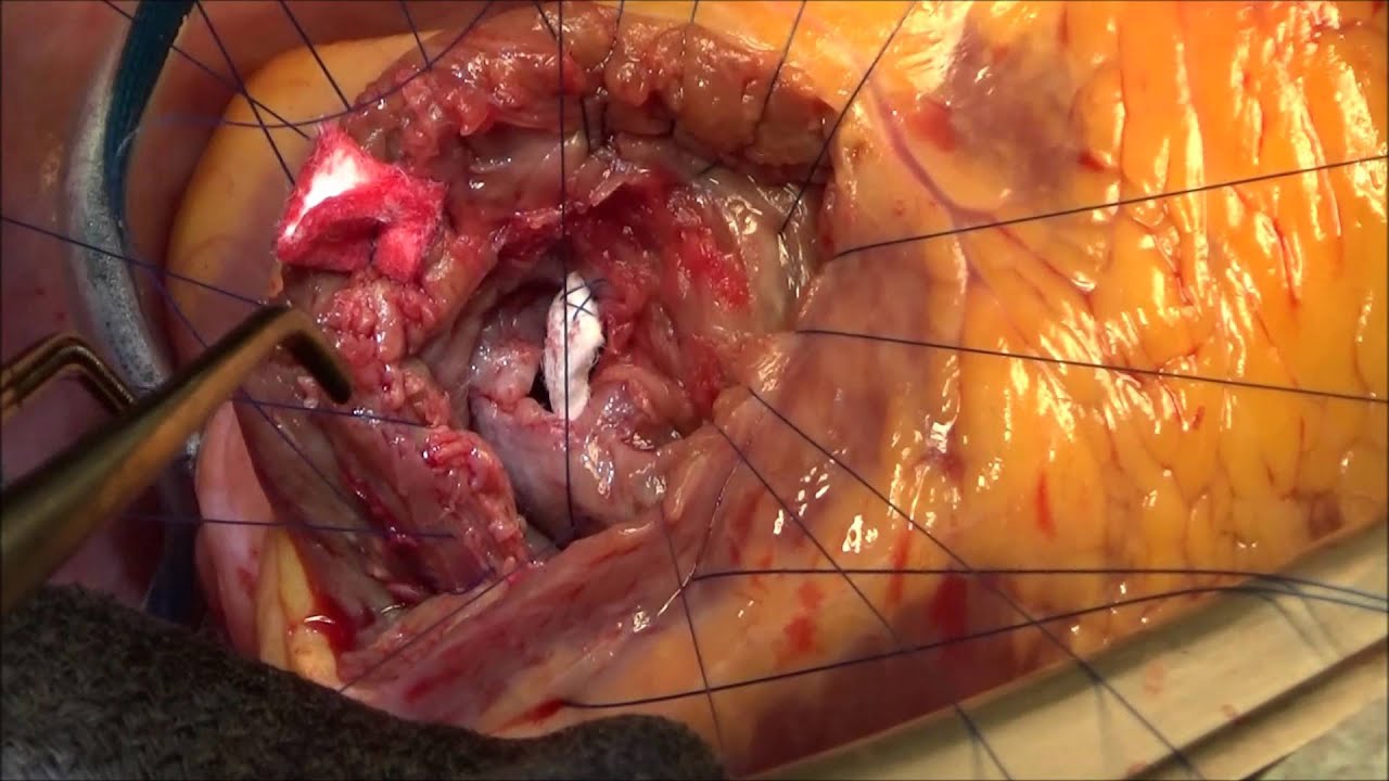 CIV post Infarctus du myocarde - YouTube