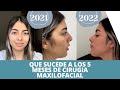 Mi experiencia 5 meses post cirugía maxilofacial