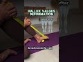 Valgus feet Exercises #youtube #duet #viral