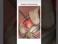 rotator cuff repair #mbbs #shorts