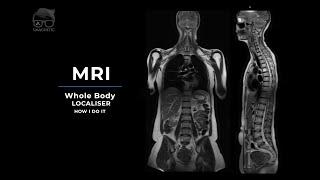 MRI - WHOLE BODY LOCALISER - How I Do It