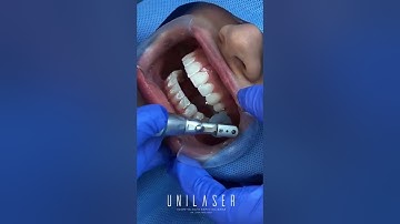 Shiny smiles with Unilaser- Bonding veneers