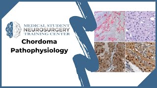 Chordoma Pathophysiology