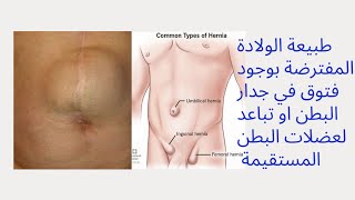 الولادة طبيعي أم الولادة القيصرية عند وجود فتق في جدار البطن