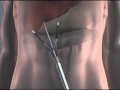 STARR Treatment Minimally Invasive Weight Loss Surgery-How Spider works