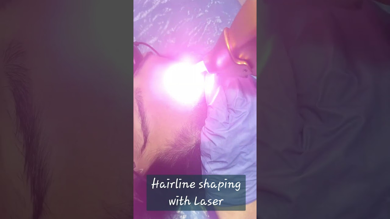 Laser Hair Reduction for hairline at Myra skin and hair solutions, Delhi 