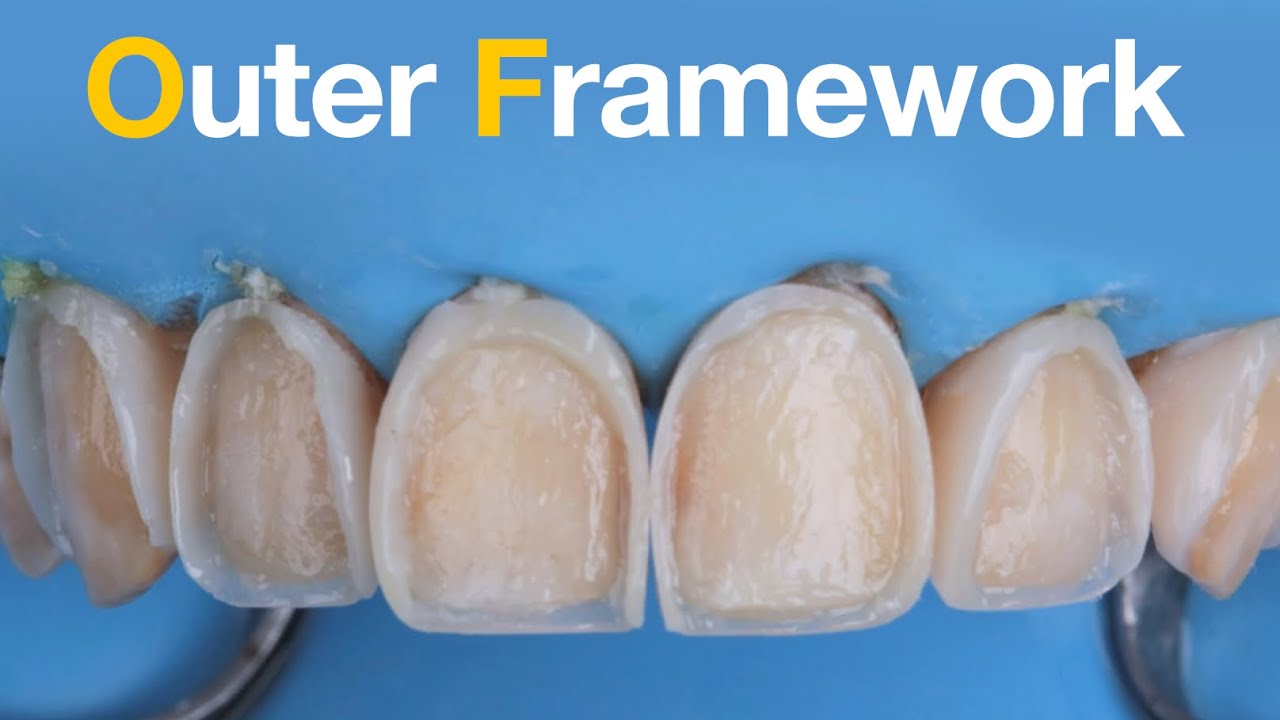 Tips series 3 how to build proximal walls using unica matrix? YouTube