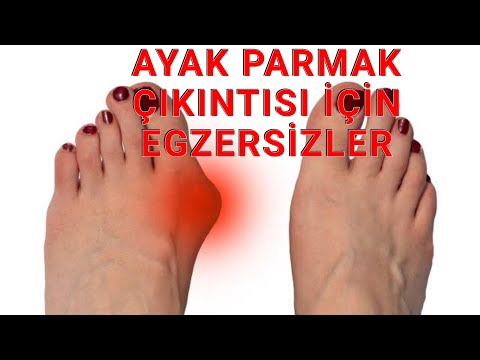 AYAK PARMAK ÇIKINTISI VE EGZERSİZLERİ (HALLUKS VALGUS)