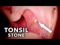 TONSIL STONE + A Touch of Pneumonia | Dr. Paul