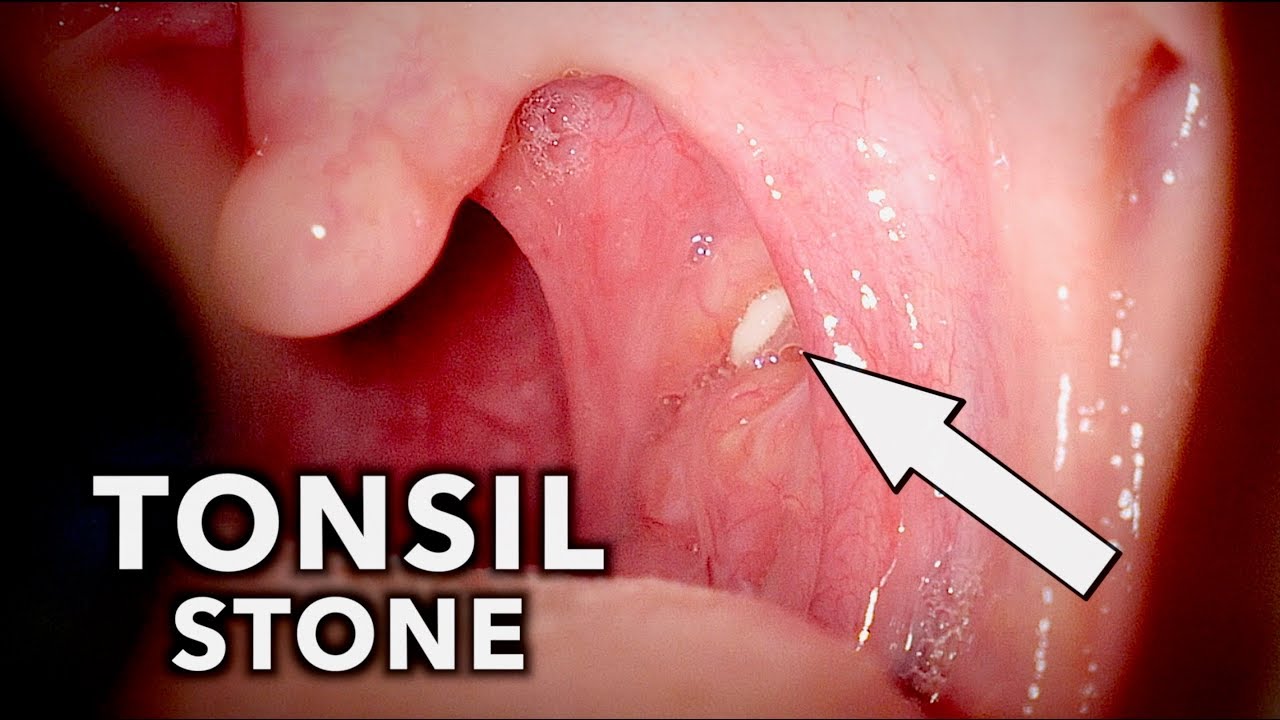 Aspiration #caséum #amygdale, #Tonsil #stone removal. Dr Danvin JB #me