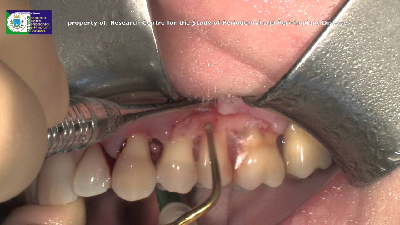 インサートチップOT13｜株式会社インプラテックスの取扱い商品