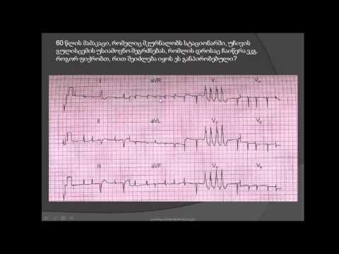 მოციმციმე არითმია (წინაგულების ფიბრილაცია), პარკუჭოვანი ექსტრასისტოლები და პარკუჭოვანი ტაქიკარდია