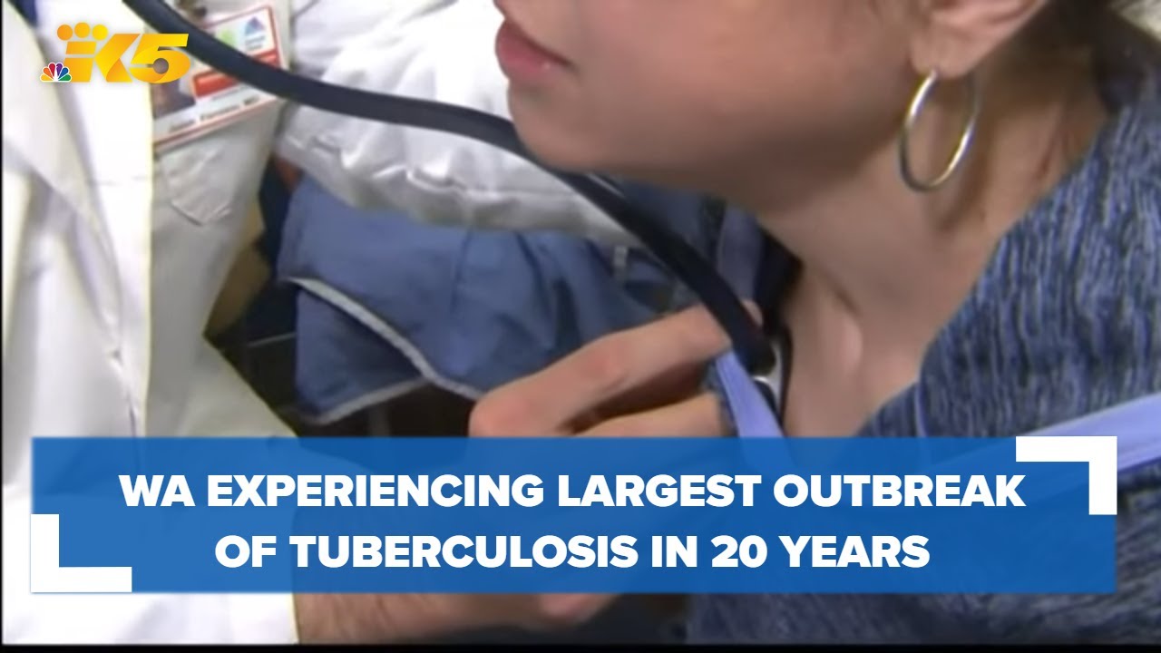 Washington experiencing largest tuberculosis outbreak in 20 years