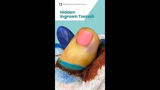 Hidden Ingrown Toenail #ingrowntoenailtreatment #ingrown_toenail_surgery #footdoctor