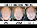 Homemade topical finasteride results 5 months