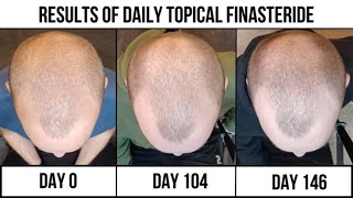 Homemade Topical Finasteride Results (5 months)