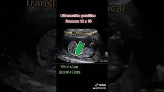 Ultrasonido Genético Translucencia Nucal