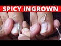 Ingrown toenails treatmentalmas manicure and pedicure vlogsjoyful initial result