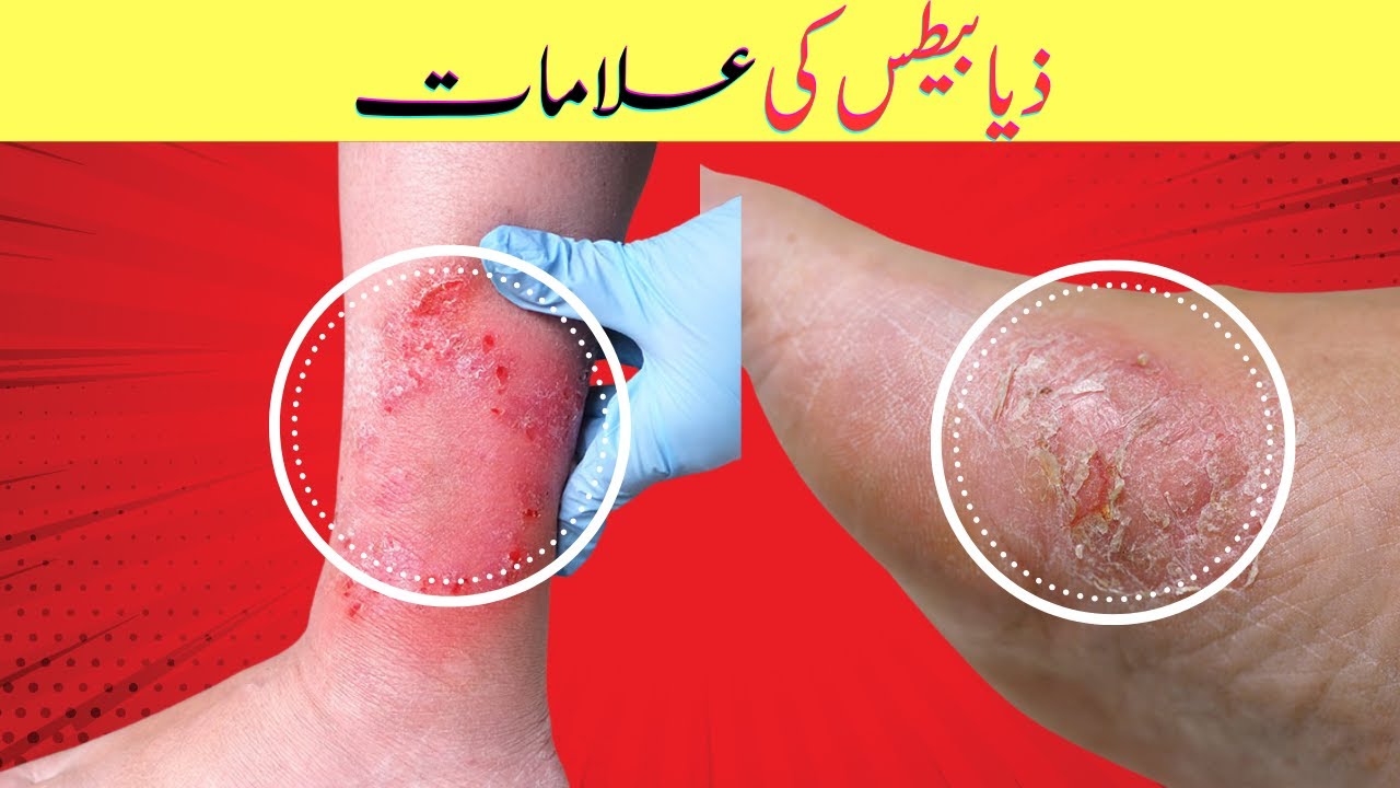 Signs Of Diabetes| Type 2 Diabetes In Men & Women