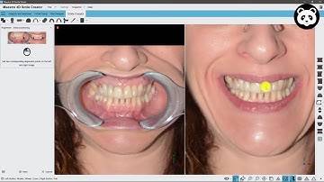 Maestro 3D | Dental Studio | Smile Creator | Digital Mockup | 3D Denture Guide