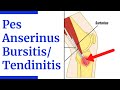 Pes Anserine Bursitis Tendinitis Evaluation 