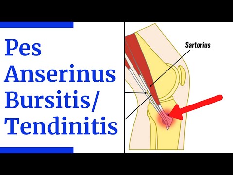 Pes Anserine Bursitis/Tendinitis Evaluation