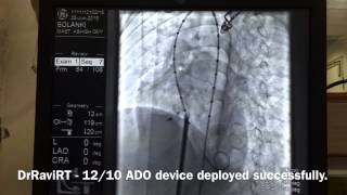 DrRaviRT - Large Perimembranous VSD Device Closure using PDA device.