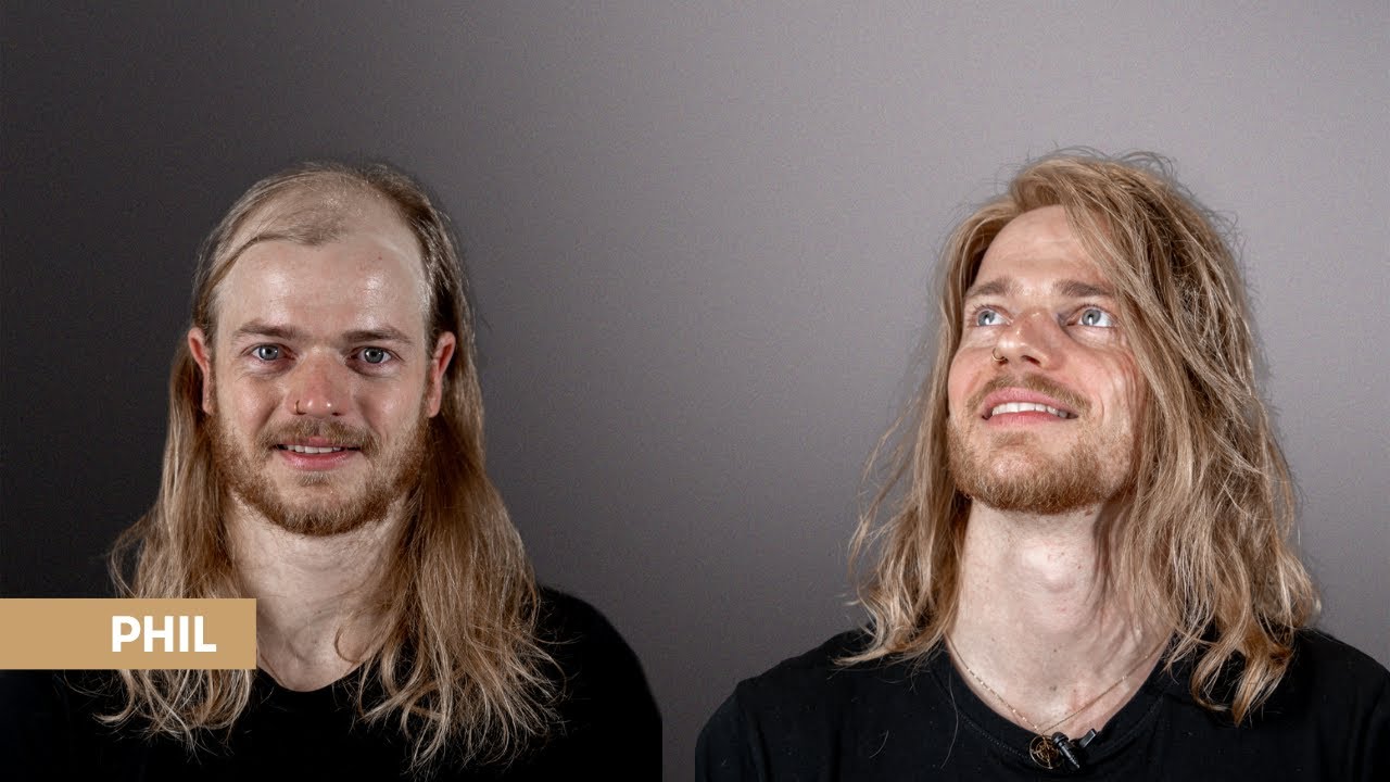 Cooler Surfer Look für Männer trotz Haarausfall - Phil aus Berlin bekommt sein Haarsystem bei O.C.